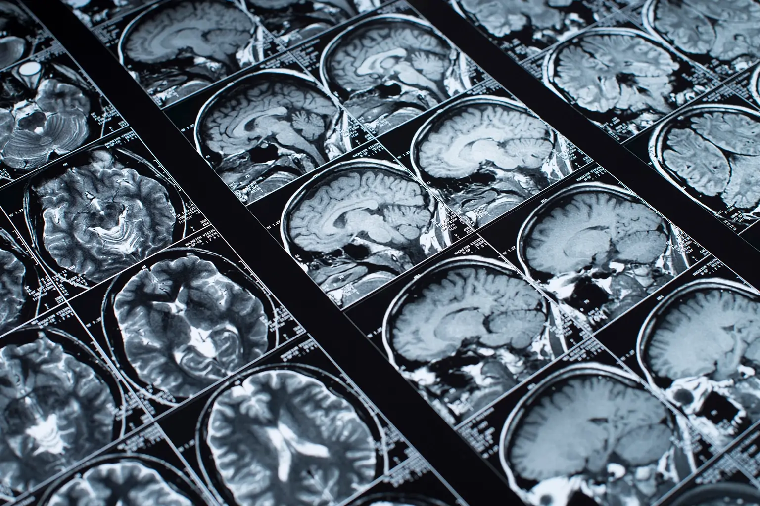 Blue-toned brain MRI scans arranged on a dark diagnostic display